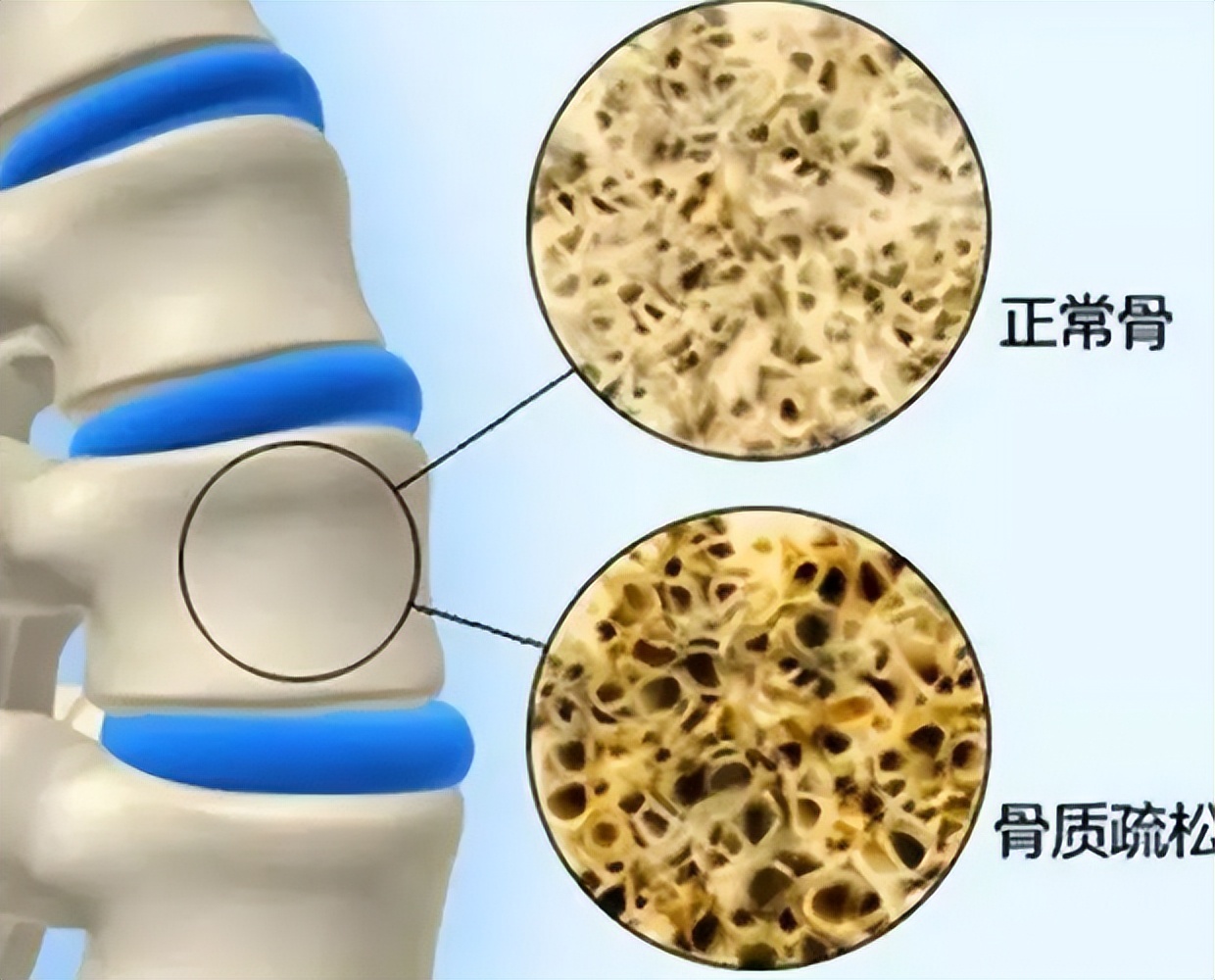 骨康胶囊治阴虚还是阳虚,骨康胶囊对骨质疏松有用吗