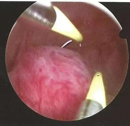 你知道宫腔镜是治疗什么的吗,宫腔镜是治疗什么的