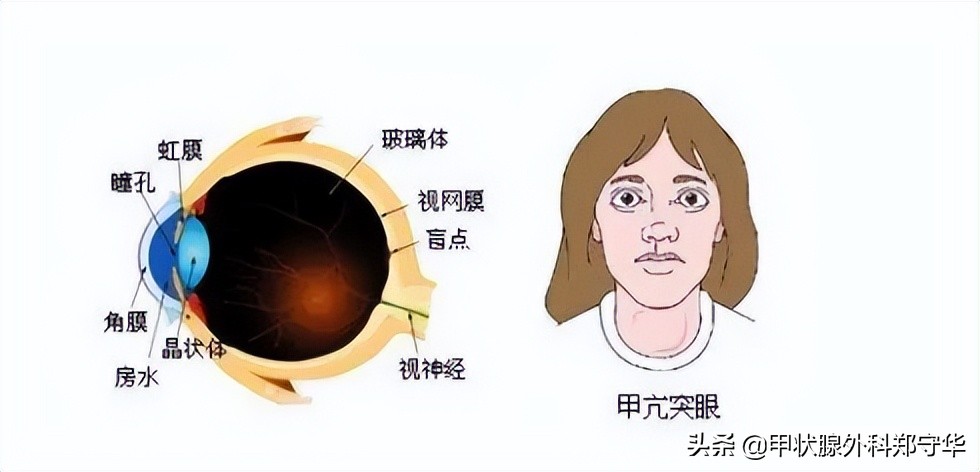 十个甲亢患者，九个有这个坏习惯，赶快自查