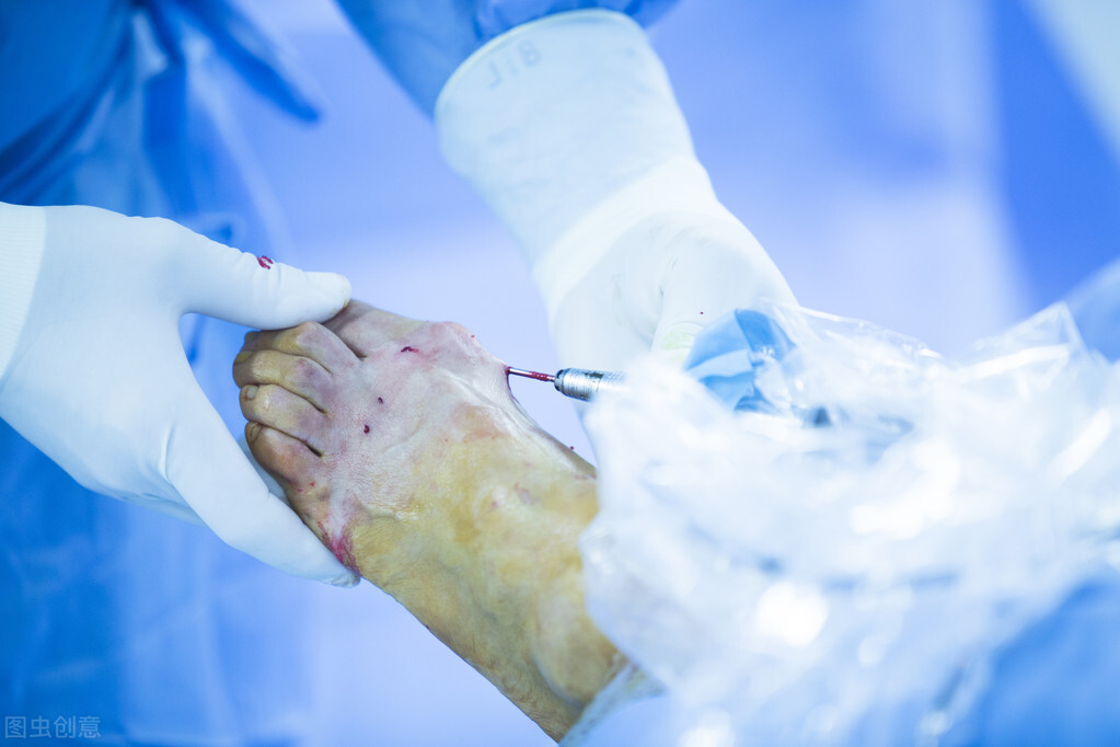 拇外翻手术后脚还在肿是什么原因,脚骨折手术后三个月还肿正常吗