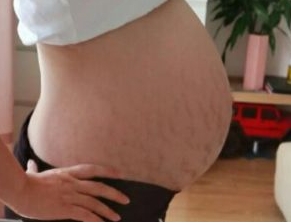 产后如何淡化妊娠纹一个妙招,产后淡化妊娠纹最有效的方法