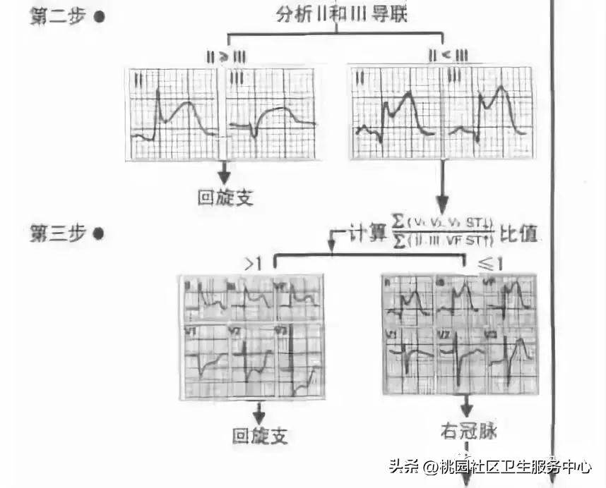 后循环梗死的识别,梗死分为哪三大类型