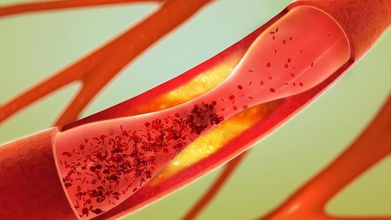 血管有自愈功能吗,血管软化的四大误区