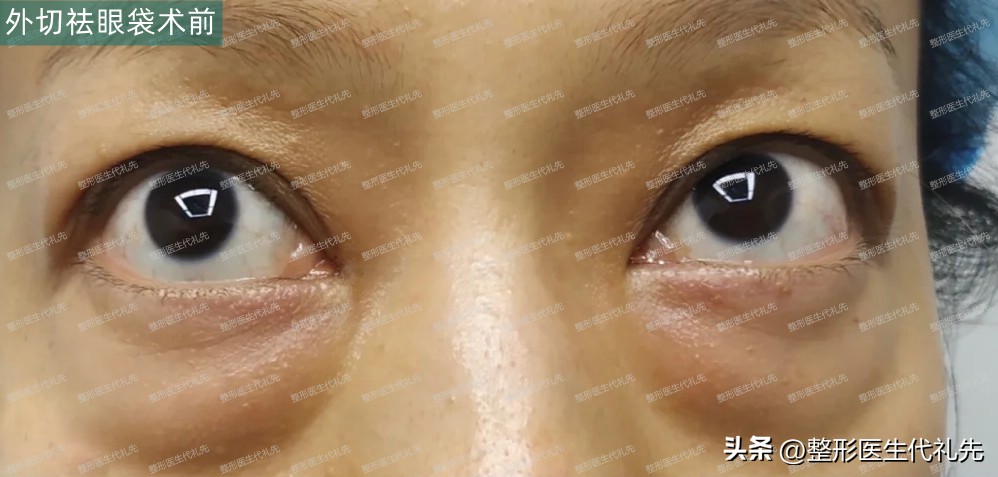眼袋手术52天,眼袋手术27天了还用抹祛疤膏吗