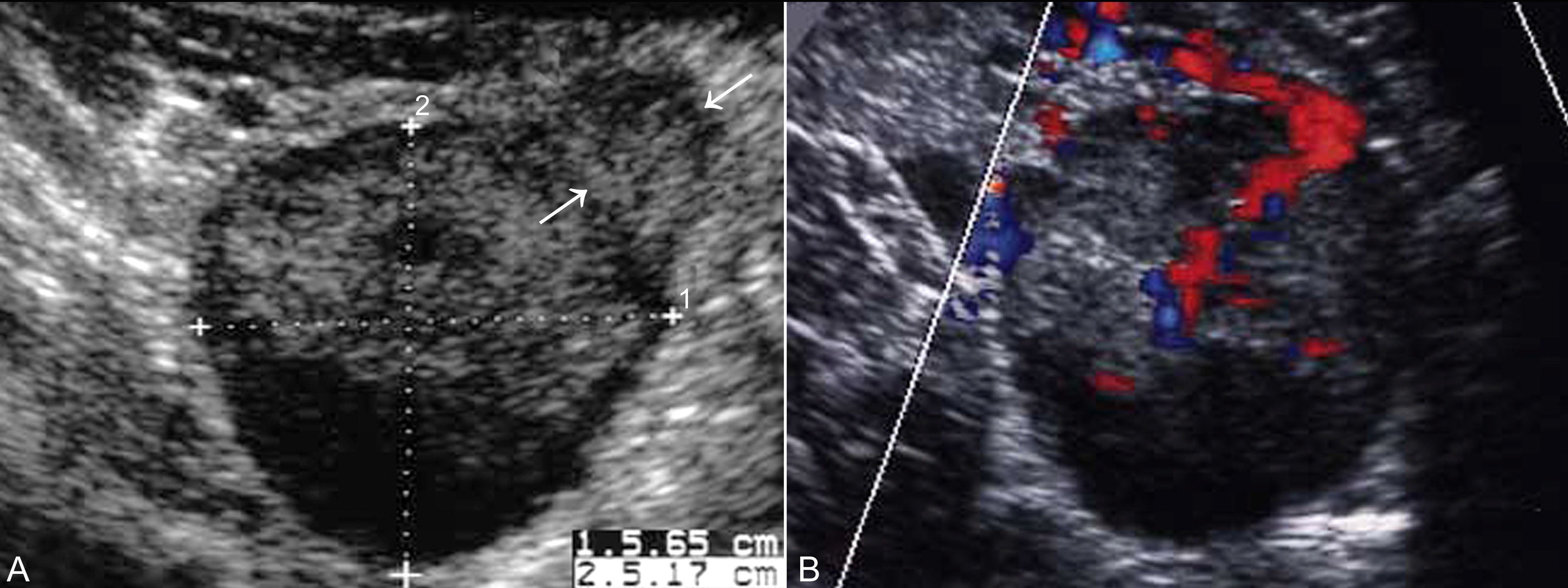 妊娠合并卵巢良性肿瘤,妊娠合并卵巢肿瘤是恶性吗