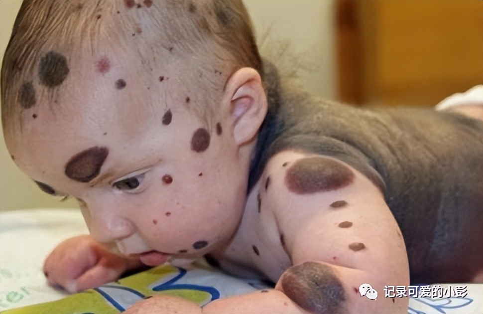 20岁少女产下混血女婴,20岁女子产下胎儿畸形