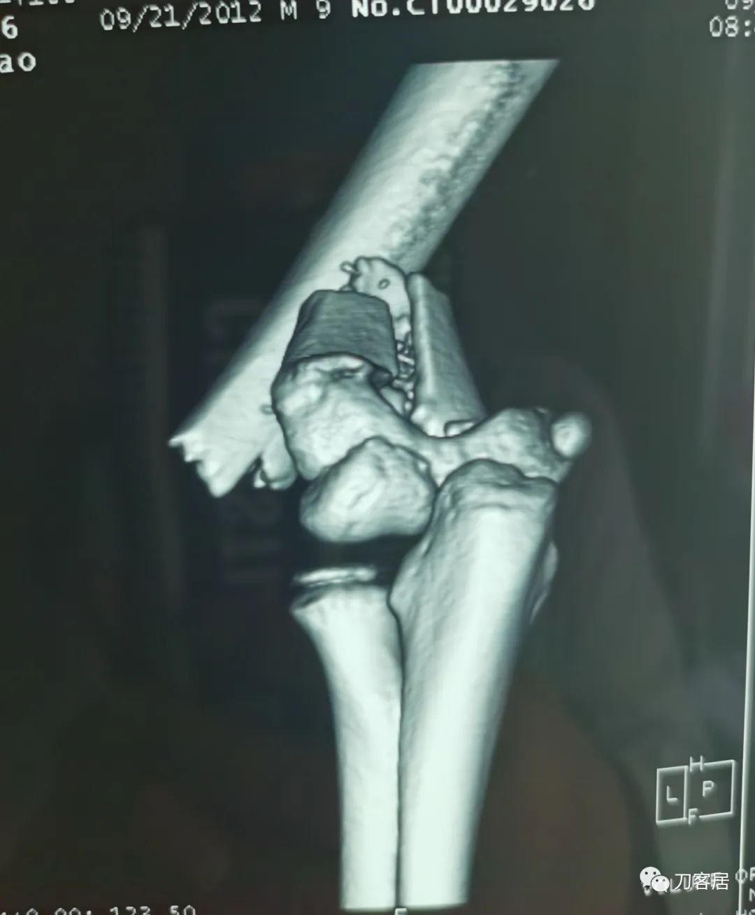 孩子胳膊摔伤肿了不能弯曲一直疼,9岁男孩摔倒手臂痛怎么办