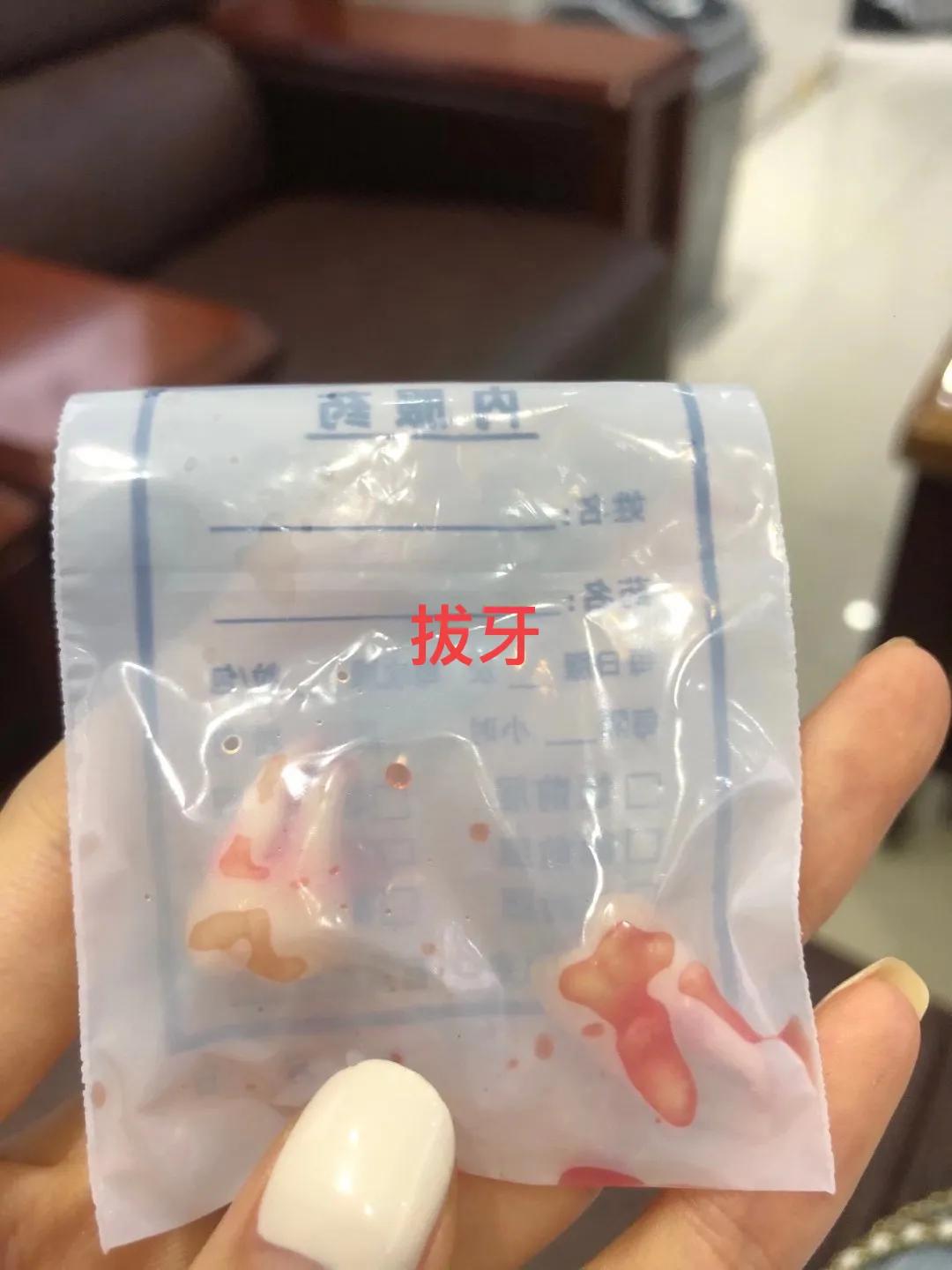 牙齿矫正需要多少钱呢前后对比图,牙齿矫正最多需要多少钱