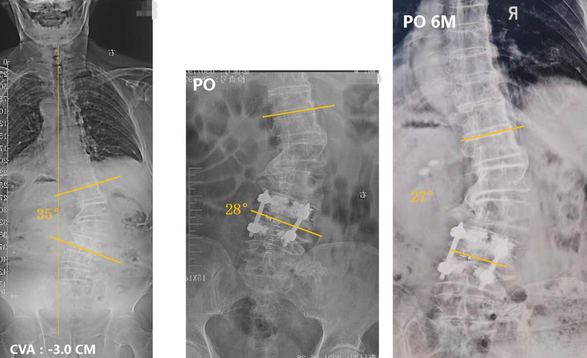 老年人脊柱侧弯的危害和症状,老人脊柱侧弯腰部疼痛怎么缓解