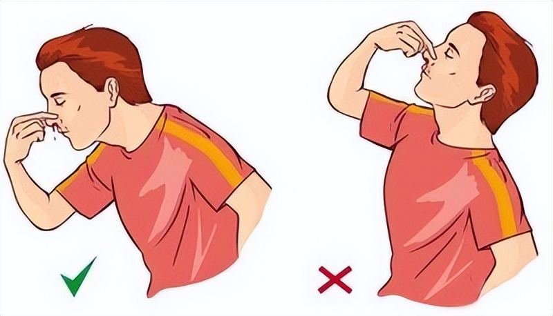 鼻出血处理技术及相关知识,医学科普动画鼻出血