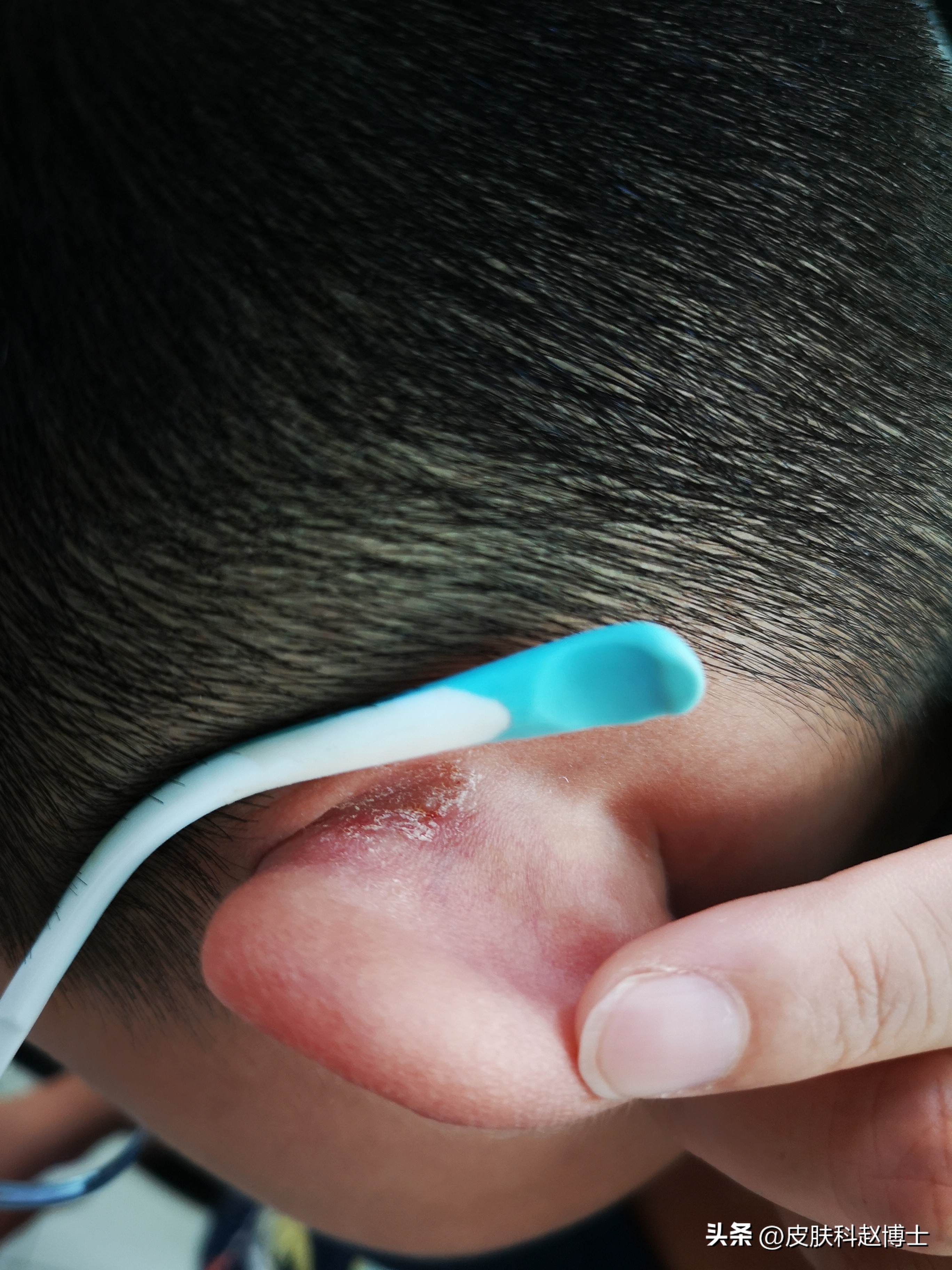 过敏湿疹反复发作如何除根,湿疹反复发作找不到病因