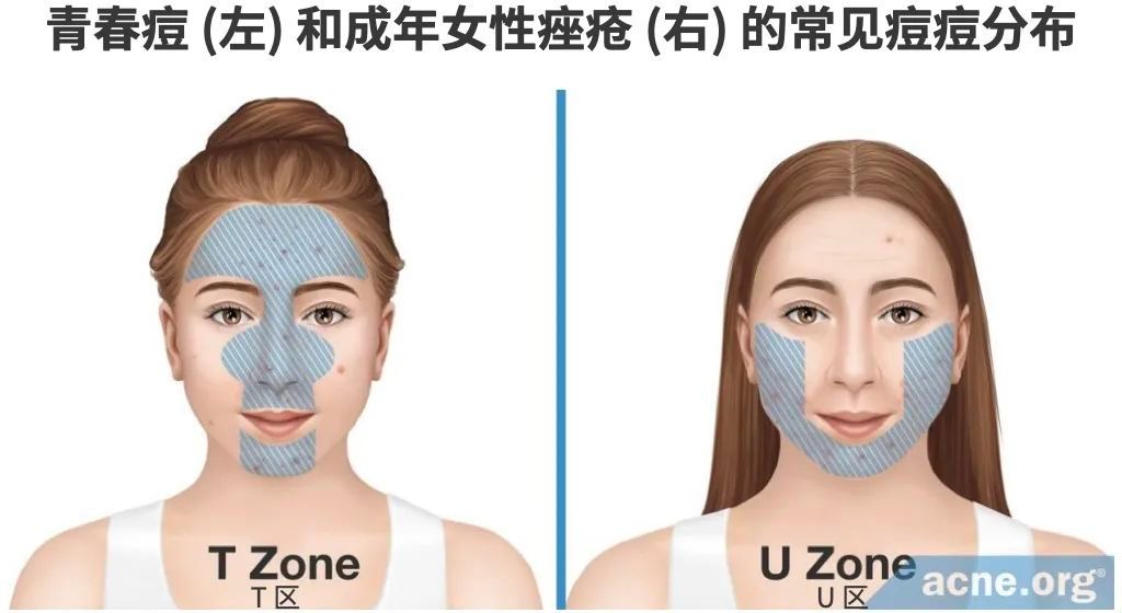 成年人崩溃的一瞬间就是反复长痘...