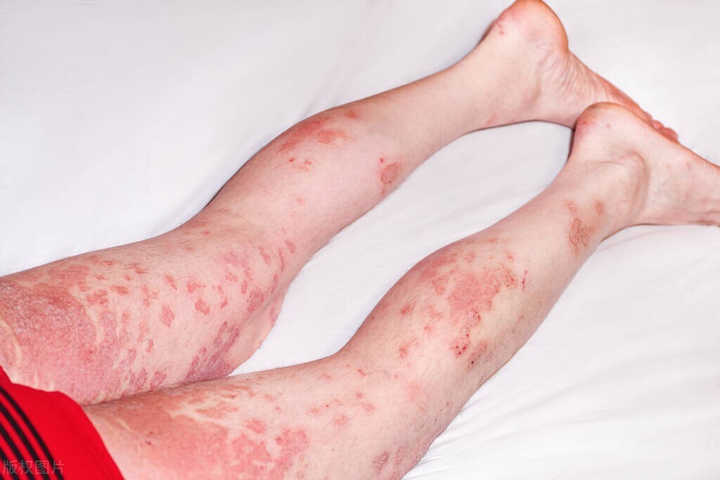 早期艾滋会出现什么皮肤病,不要错把艾滋当皮肤病
