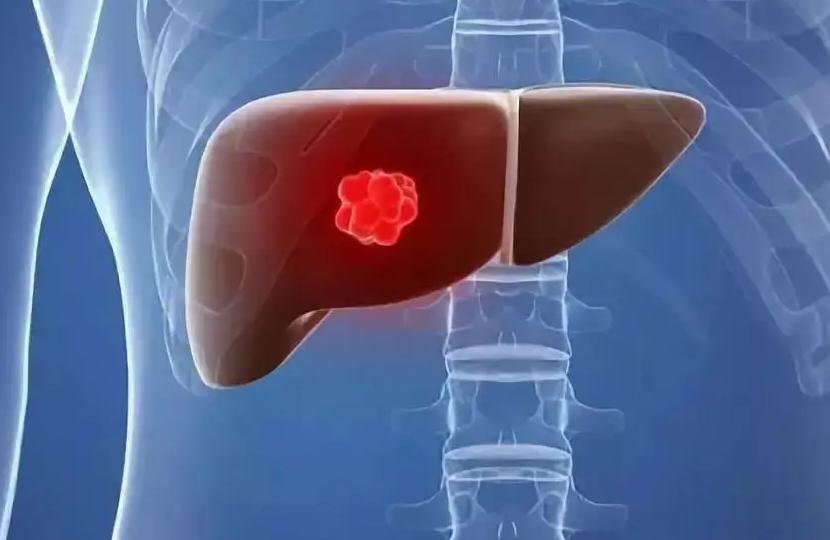 人体内肝吸虫与寄生虫区别,如果是寄生虫感染肝脏要不要吃药