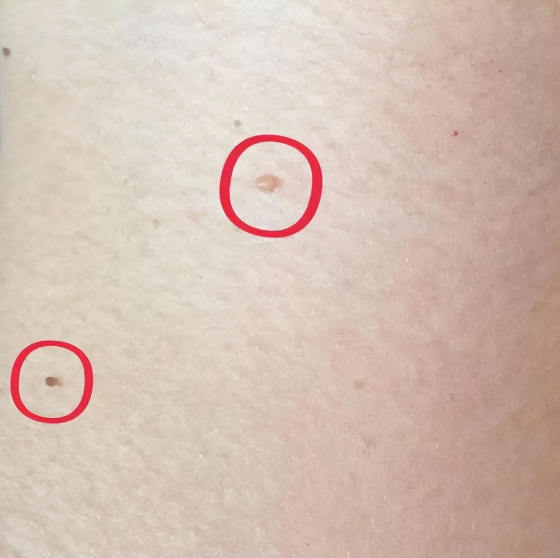 脖子腋下的小肉粒是什么,脖子腋下长小肉粒可以用手揪掉吗