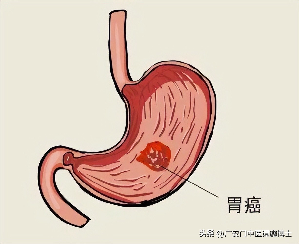 让胃癌患者晚期减少痛苦的方法,中期胃癌的治疗方案