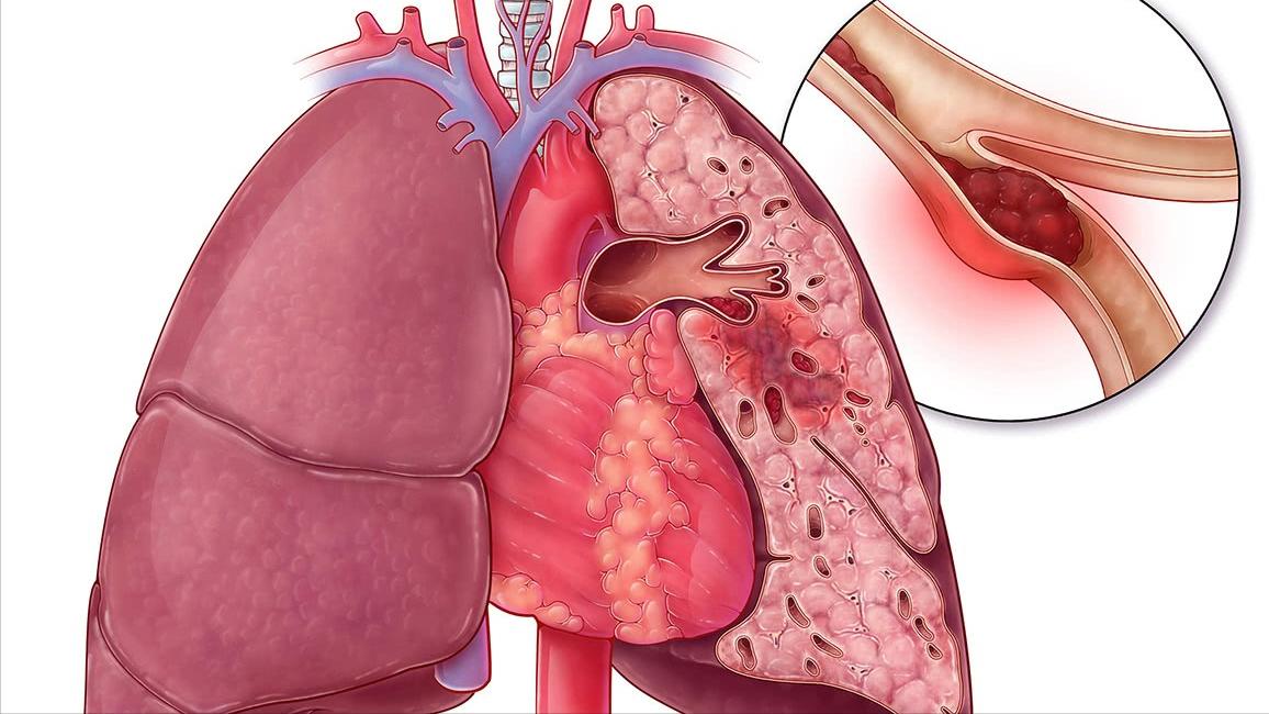 咽喉炎肺会有症状吗,如果咽喉肿痛怎么办