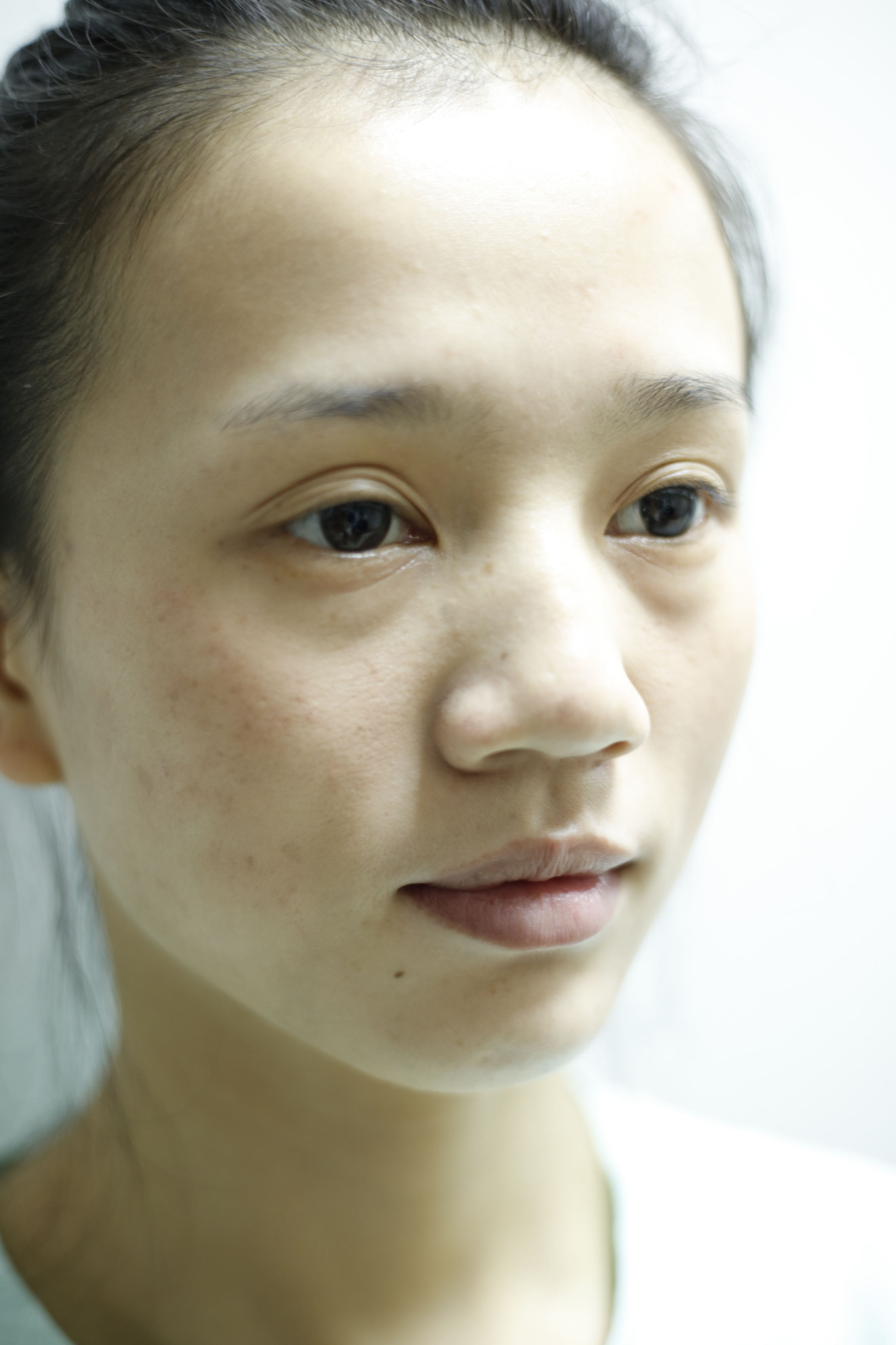 再漂亮的小姐姐也会被痘印困扰，治疗完后感叹激光治疗效果真不错