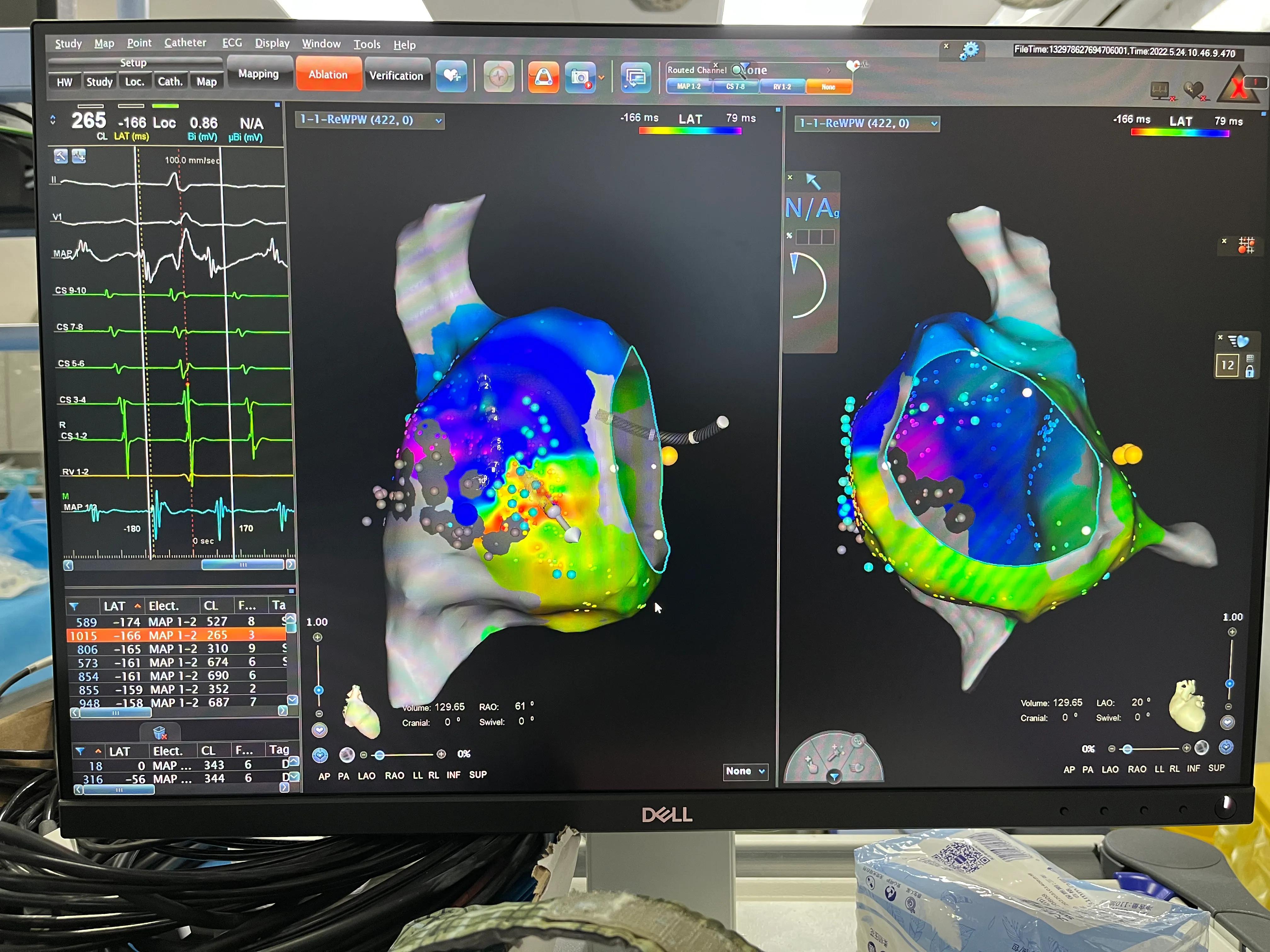 窦性心动过速原因,心动过速恢复方法