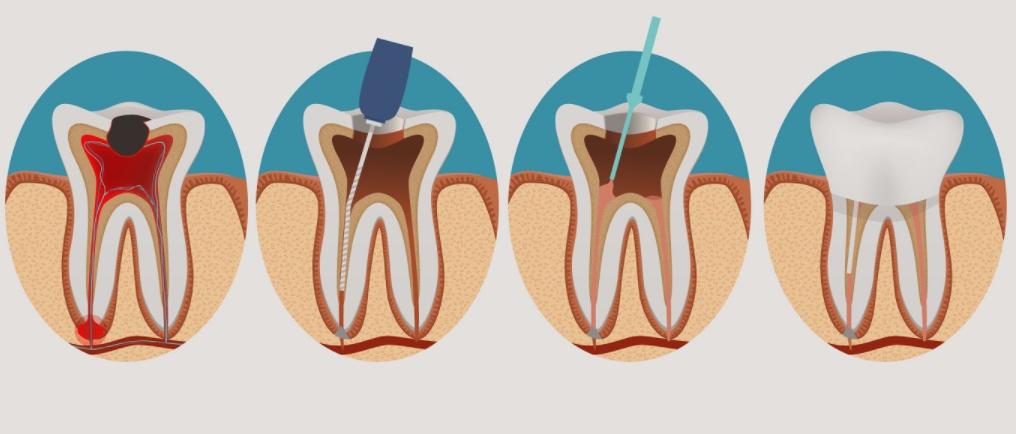 做根管治疗期间牙齿劈了,做根管治疗的牙断了一部分