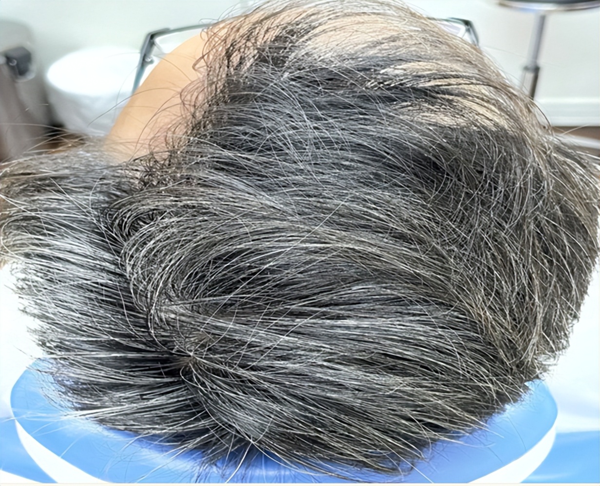 超30%阳康或有脱发风险,专家阳康后超30的人面临脱发风险