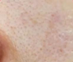 为什么会毛孔粗大长粉刺,为什么会毛孔粗大油光满面