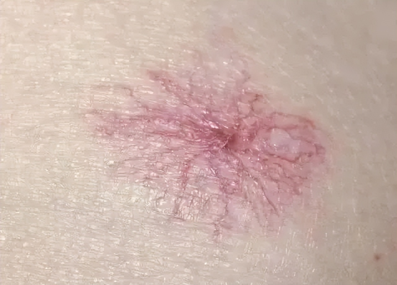 脸上长了很多痣是不是肝癌,这种痣可能是肝癌信号