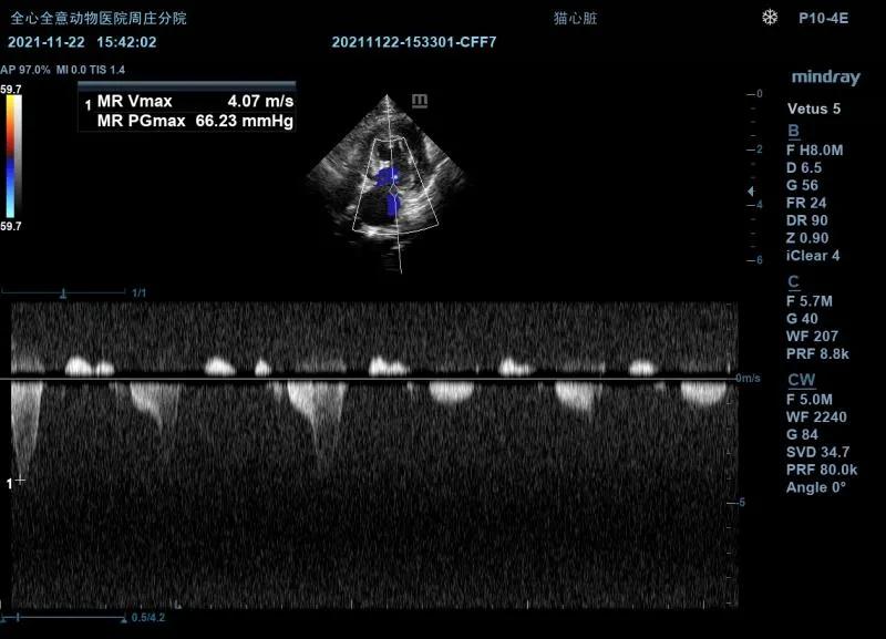 二尖瓣发育不良病例总结