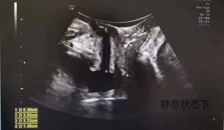 关爱女性盆底健康图片,呵护女性从盆底康复开始