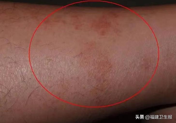 阳了后浑身痒、起疹子？医生提醒：分清类型再治疗