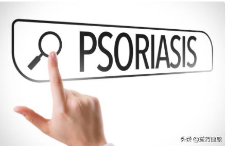 他卡西醇软膏能治牛皮癣吗,他卡西醇软膏能用于头皮银屑病么