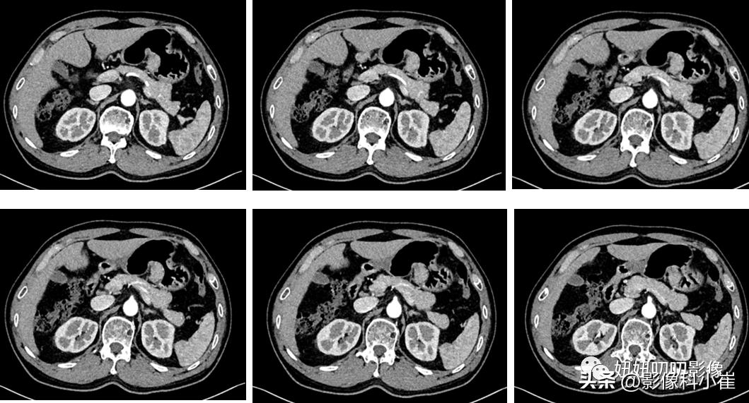 异位胰腺是什么病,典型的异位胰腺