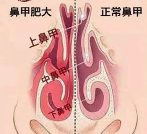 鼻充血鼻塞如何根治,鼻塞不通气鼻甲肥大用什么药物