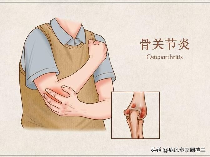 手关节疼一定是关节炎和痛风,手关节酸痛是痛风吗