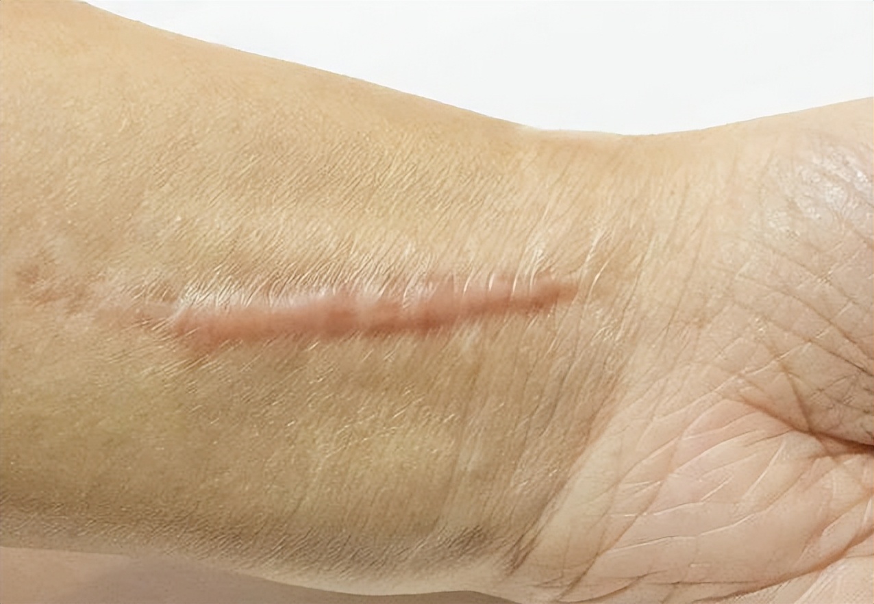 祛疤后疤痕增生怎么办,术后疤痕增生可以不使用祛疤膏吗