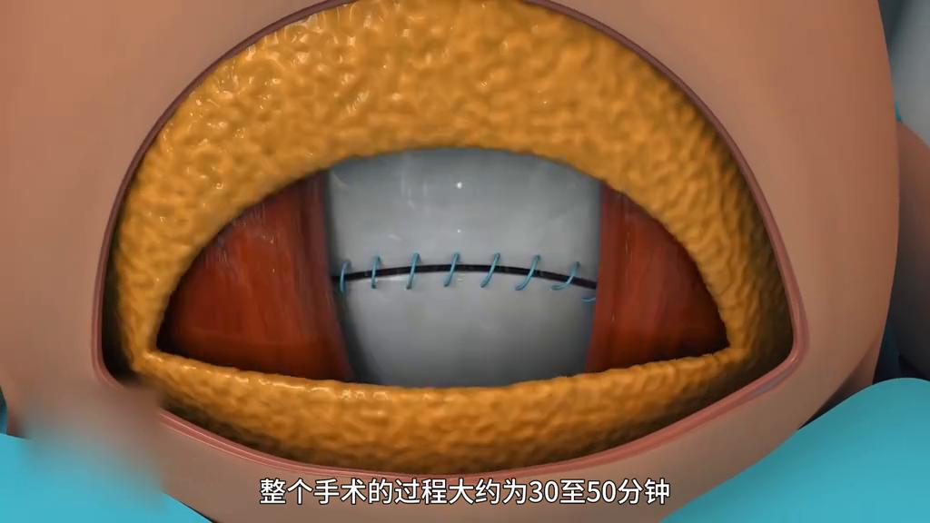 剖腹产手术全部流程真实的,剖腹产手术实操全部流程