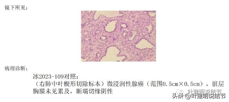 肺癌右中上叶全切,右肺上叶小结节查出是癌怎么办