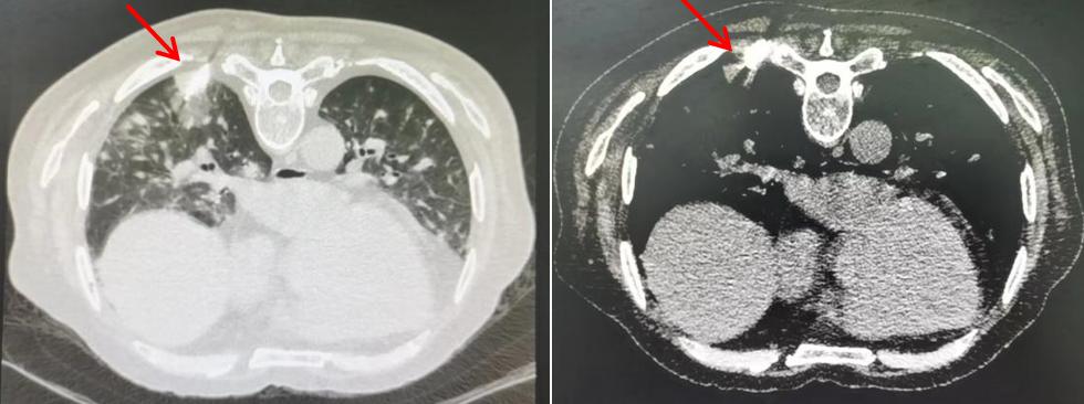 感染后稍微活动喘胸闷心悸,pjp感染