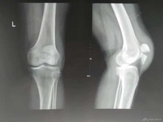 髌骨骨折的临床症状有哪些,髌骨骨折病因及发病机制