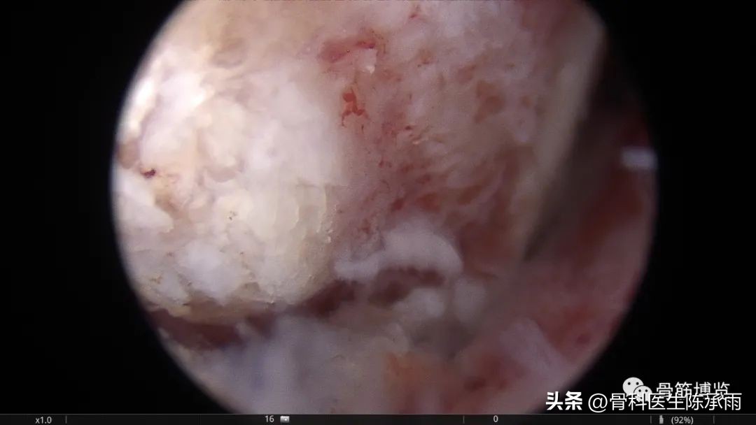 化脓性关节炎的穿刺引流治疗,关节炎镜下治疗