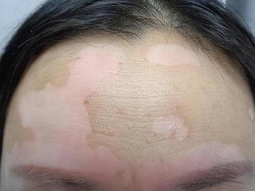 有哪些中成药治真菌肺炎,皮肤病真菌感染用什么药