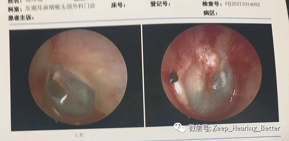 南昌大学第一附属医院鼓膜修复,南昌大学二附院耳鼻喉科专家介绍