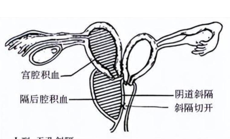 女子检查出两个子宫,女子查出双子宫