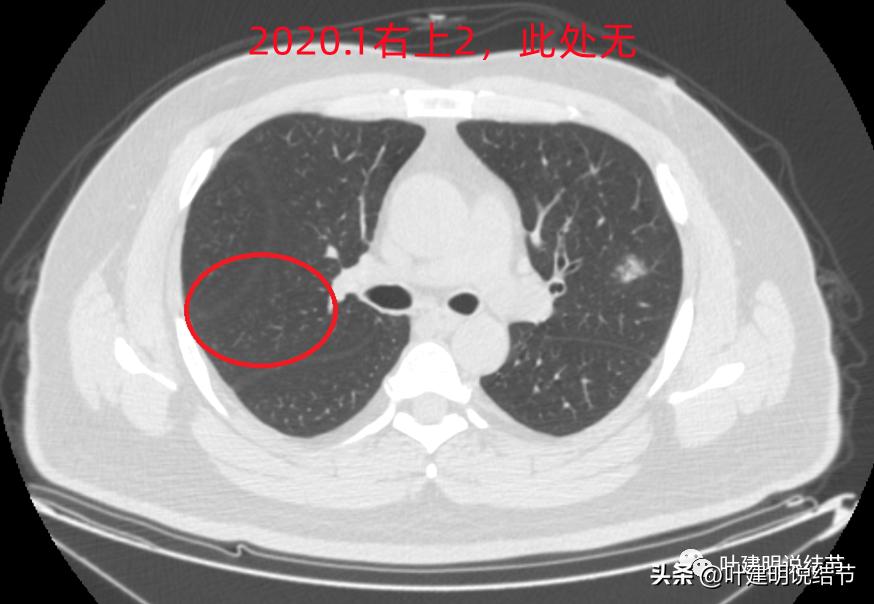 如何判断肺磨玻璃结节是高危结节,肺上有混合磨玻璃结节要注意什么