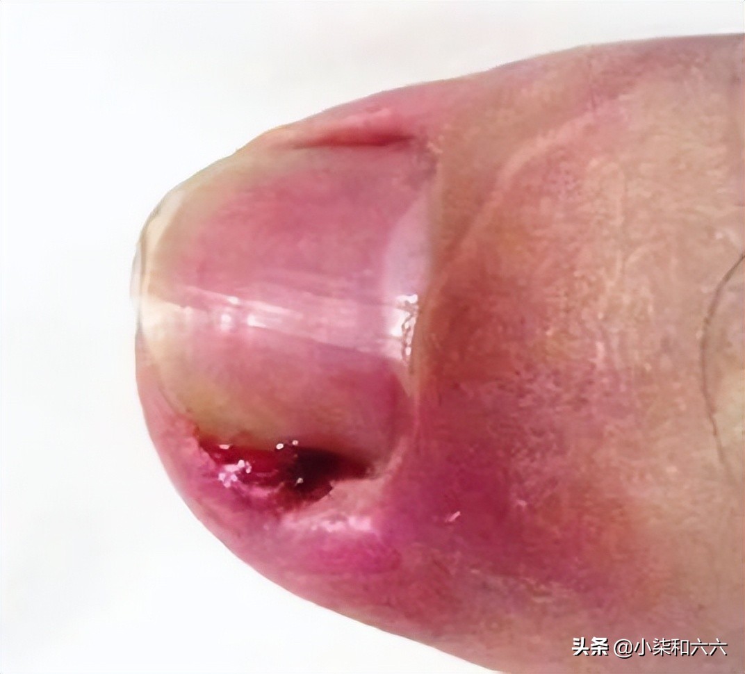 得了甲沟炎该怎么办？千万别急着拔甲