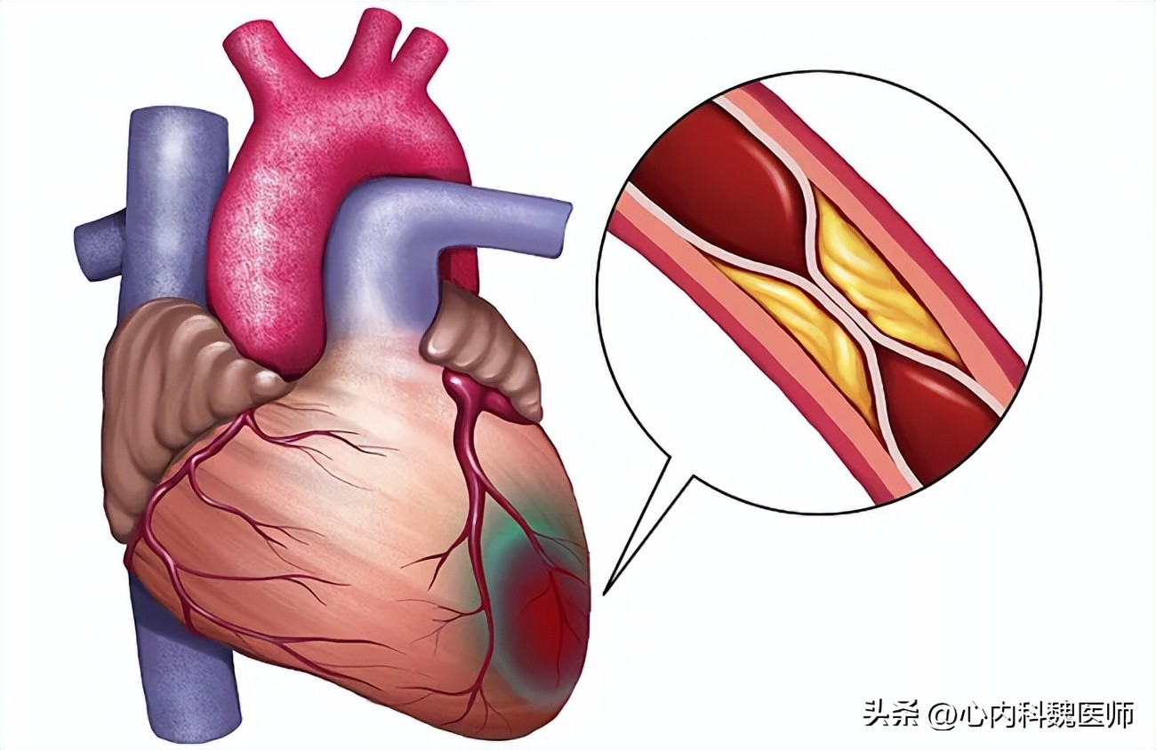 老年人房颤引起中风严重吗,缺血性中风和房颤中风区别