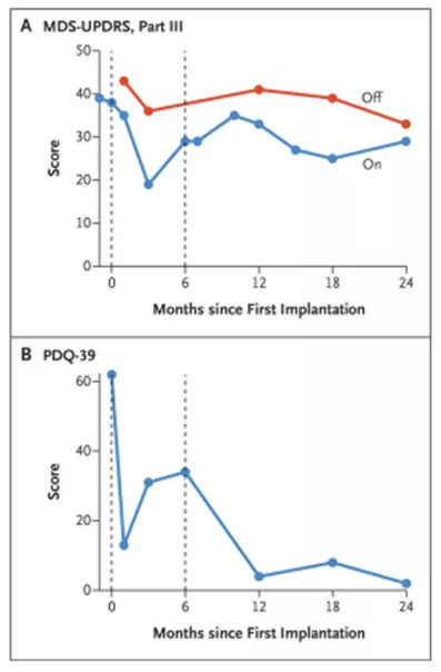 干细胞治疗帕金森技术的最新突破,干细胞治愈帕金森成功案例