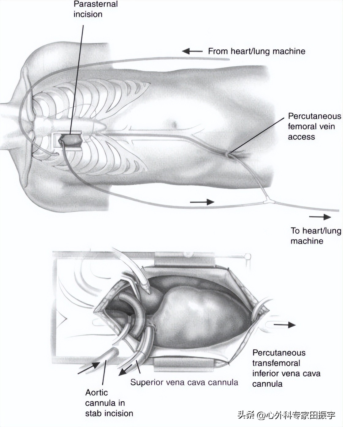 二尖瓣成形术,二尖瓣成形术后需要静养多久