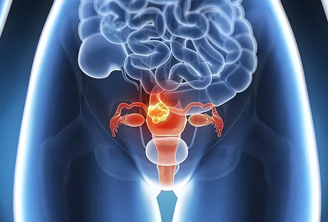 petct对各类肿瘤诊断的准确率,已确诊宫颈癌还有必要做petct吗
