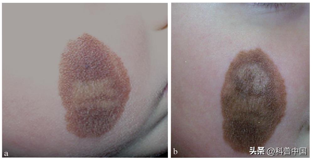 怎么判断身上的痣变癌,痣的病变到癌需要多长时间